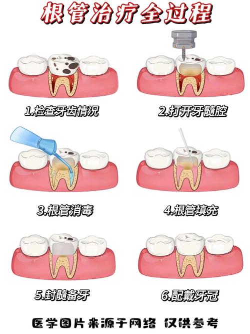 牙髓炎患者开髓治疗时临床常用麻醉方法有哪些?不同麻醉方式的优缺点及适用人群如何选择?-图2 牙髓炎患者开髓治疗时临床常用麻醉方法有哪些?不同麻醉方式的优缺点及适用人群如何选择?-图2