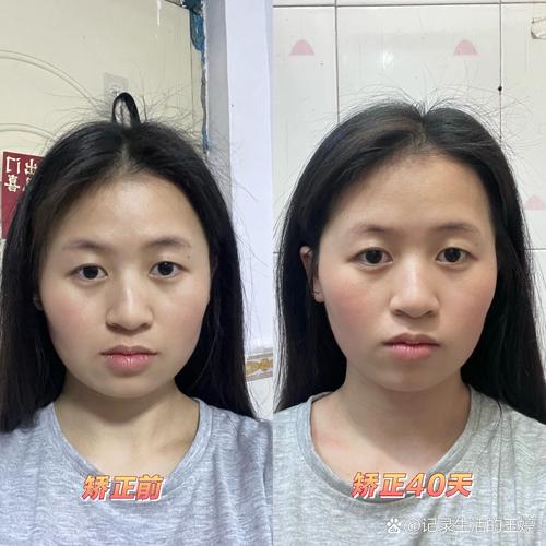 牙齿正畸前后脸型变化图片靠谱吗?正畸医生揭秘面部轮廓改善的真实原理与注意事项-图2 牙齿正畸前后脸型变化图片靠谱吗?正畸医生揭秘面部轮廓改善的真实原理与注意事项-图2