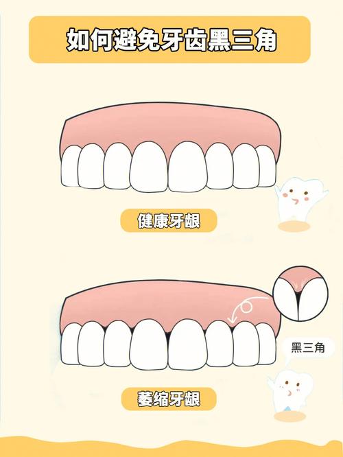 消除牙齿黑三角的有效方法有哪些?矫正、树脂贴面还是牙周治疗?哪种更适合不同情况的牙齿?-图3 消除牙齿黑三角的有效方法有哪些?矫正、树脂贴面还是牙周治疗?哪种更适合不同情况的牙齿?-图3