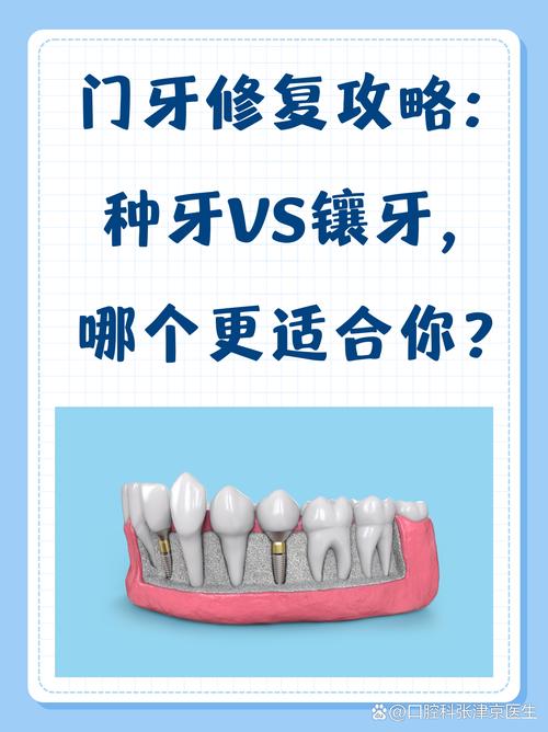 种牙、补牙、镶牙到底有何不同?修复原理、适用情况及效果差异大解析!-图2 种牙、补牙、镶牙到底有何不同?修复原理、适用情况及效果差异大解析!-图2