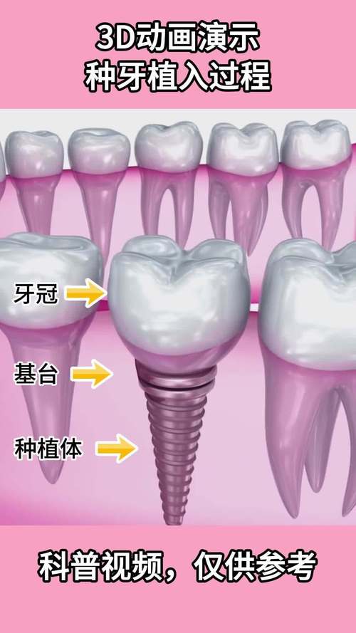 种牙过程的图片欣赏能直观展示哪些关键步骤,真实体验中又需要注意哪些细节?-图2 种牙过程的图片欣赏能直观展示哪些关键步骤,真实体验中又需要注意哪些细节?-图2