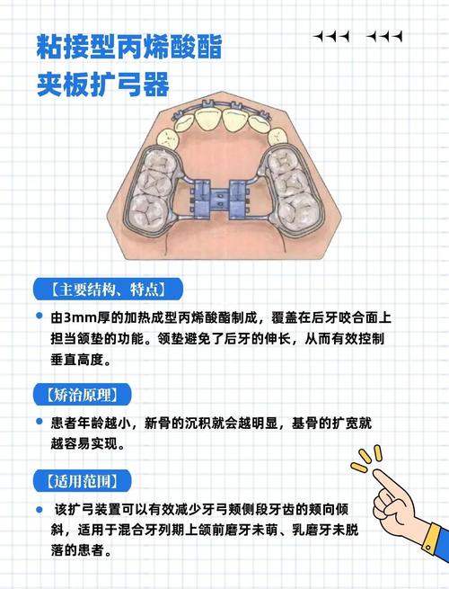 口腔正畸扩大牙弓有哪些常用技术？不同方法的原理、适应症及效果差异如何？-图1