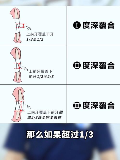 深覆合矫正方法多样，不同患者如何选择最优矫正方案？效果与风险如何平衡？-图2