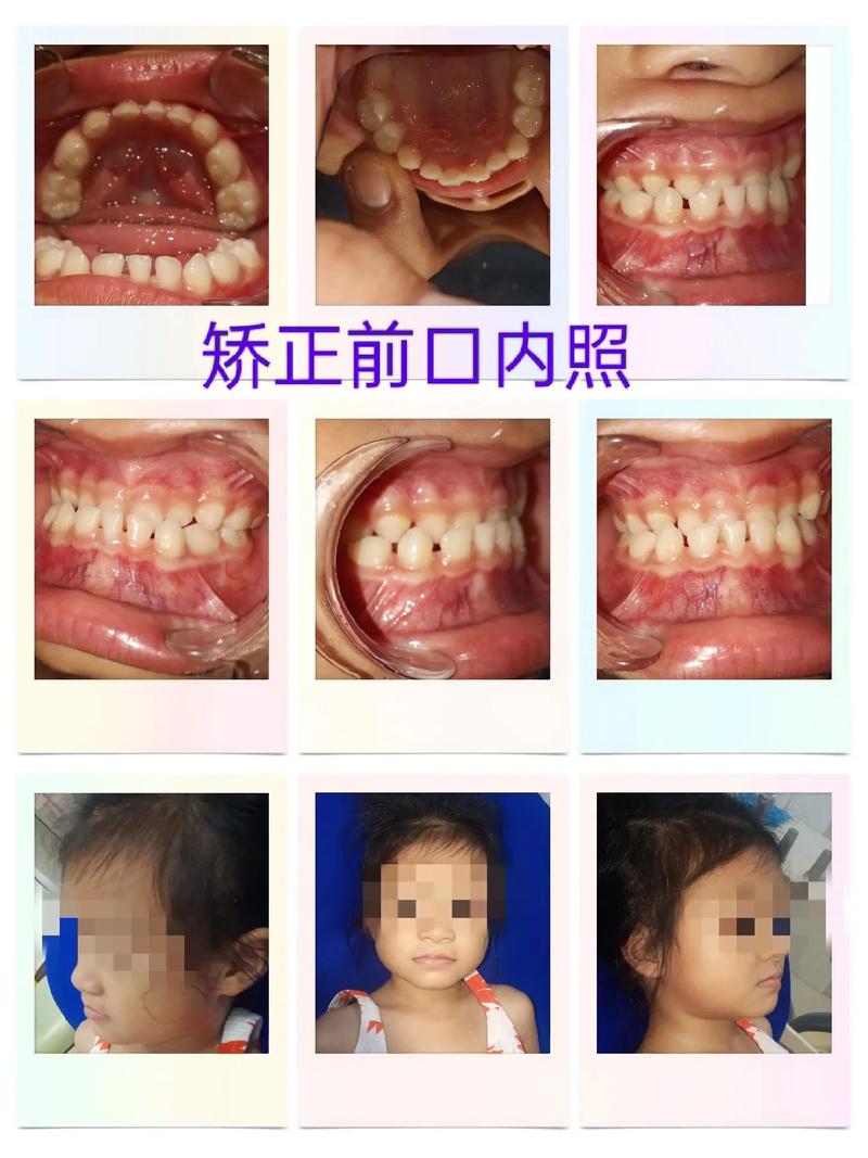 儿童反咬合(地包天)矫正有哪些常用方法?最佳干预年龄是几岁?如何选择适合的矫正方式?-图1 儿童反咬合(地包天)矫正有哪些常用方法?最佳干预年龄是几岁?如何选择适合的矫正方式?-图1