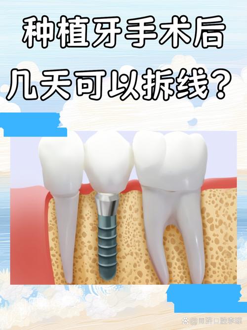 种牙拆线后,饮食、清洁、生活习惯等方面有哪些注意事项需要特别关注?-图2 种牙拆线后,饮食、清洁、生活习惯等方面有哪些注意事项需要特别关注?-图2