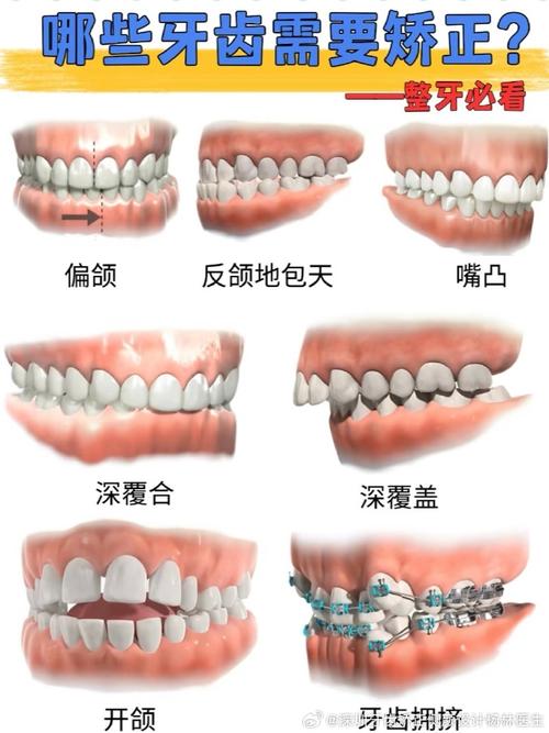 针对牙性地包天问题，临床上常见的矫正方法有哪些？不同方法各自的适用人群、矫正周期及效果如何？-图1