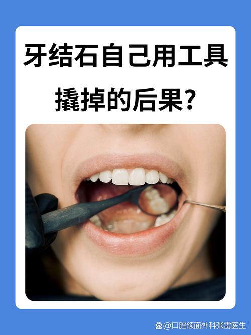 清除牙结石的好方法有哪些?不同人群如何选择安全有效的方案,日常护理能替代专业洗牙吗?-图2 清除牙结石的好方法有哪些?不同人群如何选择安全有效的方案,日常护理能替代专业洗牙吗?-图2