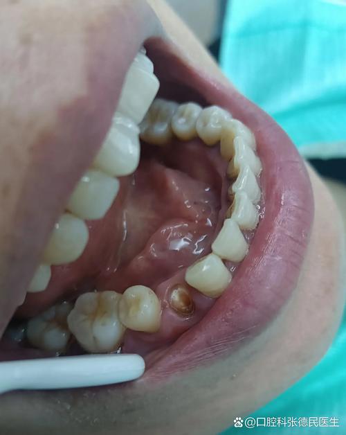 牙根缺失后还能不能种牙?没有牙根的情况下种植牙可行吗?需要满足哪些前提条件才能成功种牙?-图2 牙根缺失后还能不能种牙?没有牙根的情况下种植牙可行吗?需要满足哪些前提条件才能成功种牙?-图2