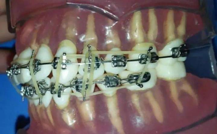 正畸关闭间隙的挂法具体指哪些技术？相关图片如何直观展示操作步骤与要点？-图3