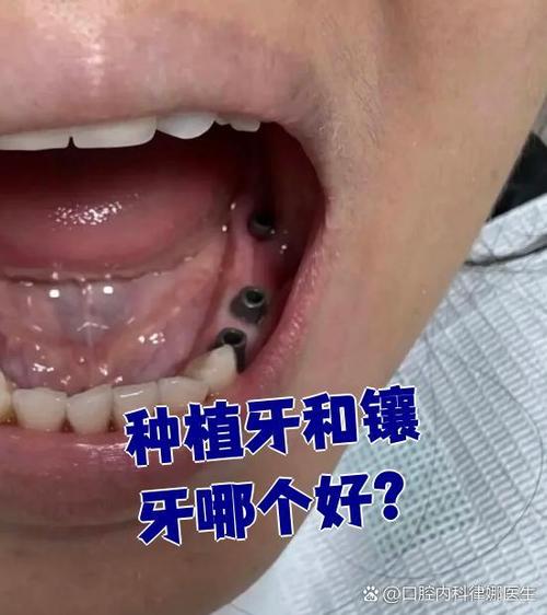 牙根完全缺失后，种植牙还有可能吗？需要满足哪些条件才能成功种牙？-图2