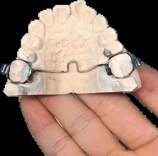 正畸腭杆如何通过增加支抗与分牙协同作用提升矫治效率？-图1