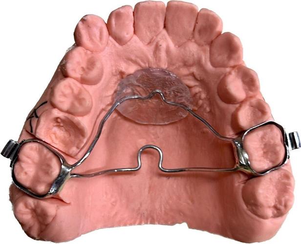 正畸腭杆如何通过增加支抗与分牙协同作用提升矫治效率？-图3