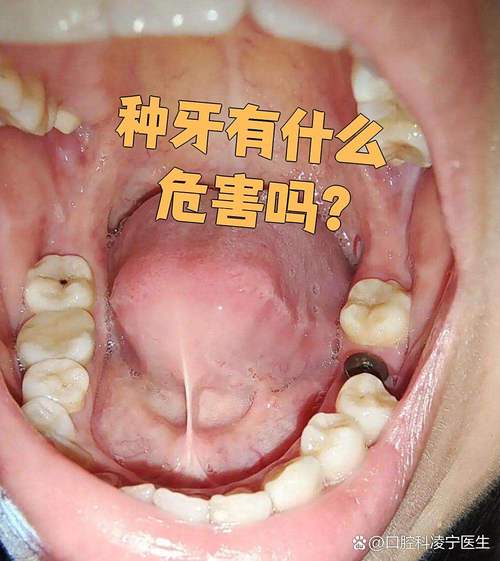 牙槽骨突出到底能不能种牙？会不会影响种植效果？需要先做哪些处理才能顺利种牙？-图2