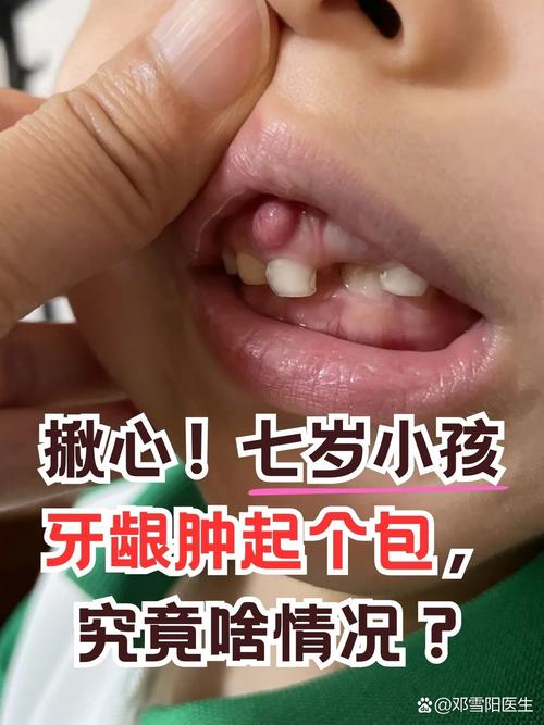 儿童牙龈炎的治疗方法有哪些?不同症状的家庭护理如何辅助专业治疗促进康复?-图3 儿童牙龈炎的治疗方法有哪些?不同症状的家庭护理如何辅助专业治疗促进康复?-图3