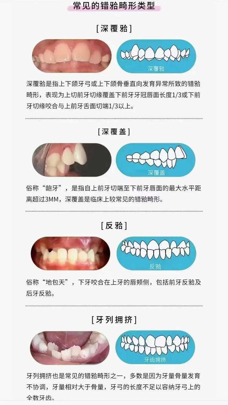 错合畸形类型多样,常见的矫治方法有哪些?不同矫正方式如何根据畸形特点与患者需求选择?-图3 错合畸形类型多样,常见的矫治方法有哪些?不同矫正方式如何根据畸形特点与患者需求选择?-图3