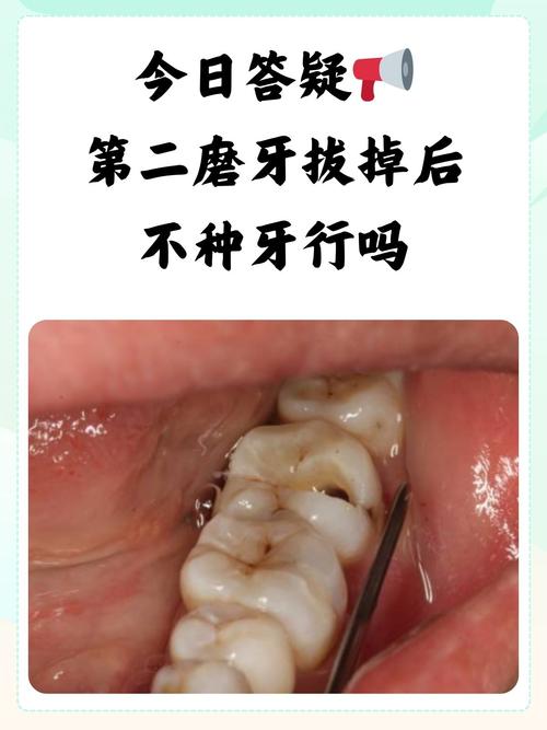 拔牙后就必须种牙吗？不种牙会有哪些隐患？镶牙、活动假牙等替代方案该怎么选？-图3