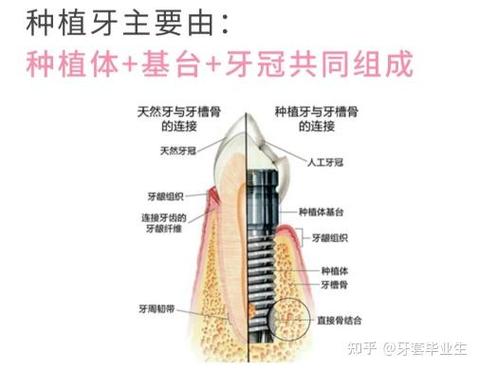 缺牙后正畸和种牙该如何选择?不同缺牙情况下的最佳修复方案是什么?-图1 缺牙后正畸和种牙该如何选择?不同缺牙情况下的最佳修复方案是什么?-图1