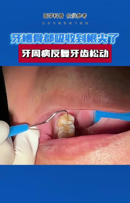 牙槽骨吸收严重到什么程度还能种牙？种牙前需要做哪些骨增量准备？成功率如何？-图3