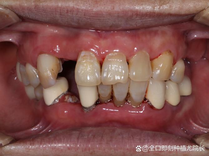 牙槽骨吸收严重到什么程度还能种牙？种牙前需要做哪些骨增量准备？成功率如何？-图2