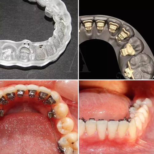 正畸托槽间接粘接技术相较于传统直接粘接，如何通过模型转移提升托槽定位精准度？对复杂病例矫正效果有何影响？-图3