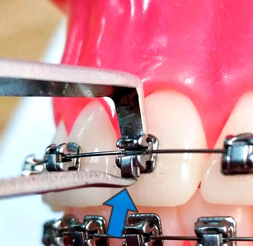 正畸托槽间接粘接技术相较于传统直接粘接,如何通过模型转移提升托槽定位精准度?对复杂病例矫正效果有何影响?-图1 正畸托槽间接粘接技术相较于传统直接粘接,如何通过模型转移提升托槽定位精准度?对复杂病例矫正效果有何影响?-图1