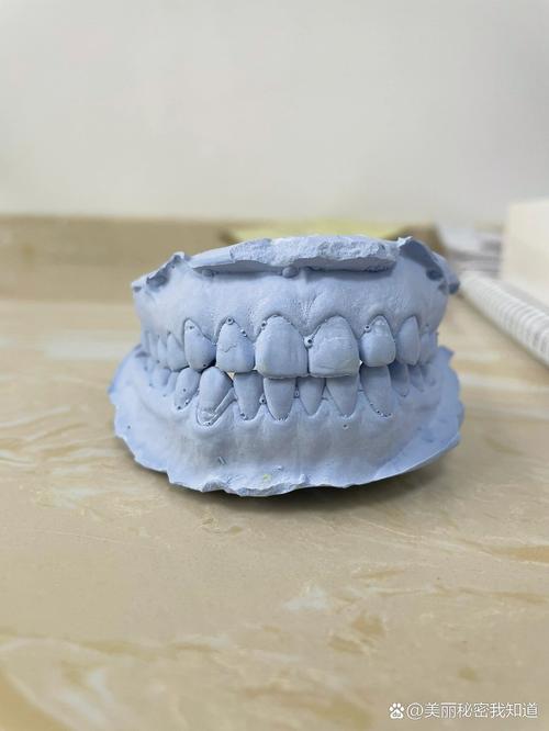 正畸咬合牙齿模型图在牙齿矫正中具体能直观呈现哪些咬合问题？对制定个性化矫正方案有何关键指导意义？-图1