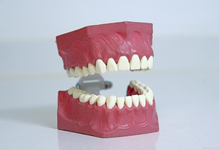 正畸咬合牙齿模型图在牙齿矫正中具体能直观呈现哪些咬合问题？对制定个性化矫正方案有何关键指导意义？-图3