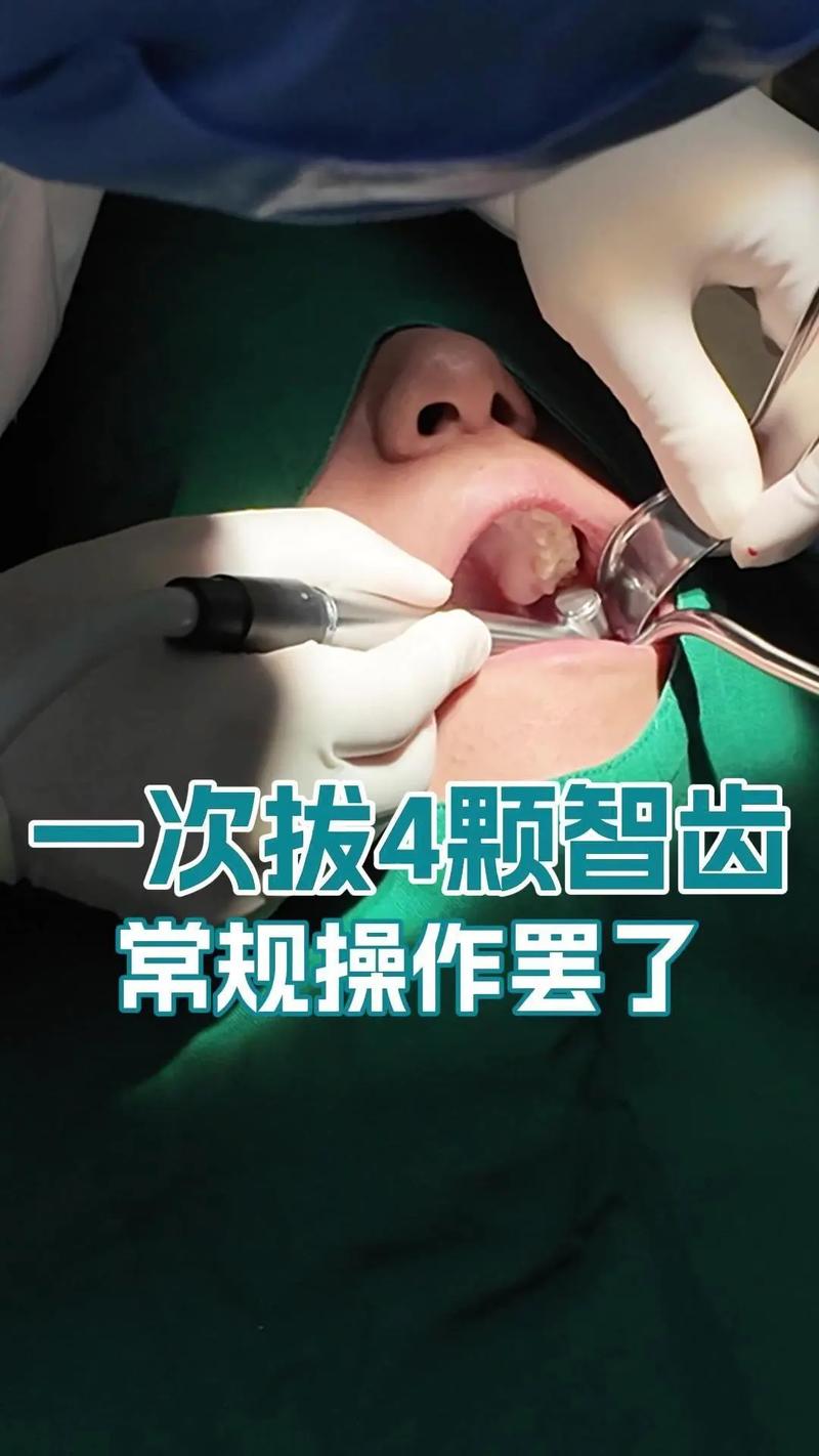 在家拔牙真的可行吗?有哪些潜在风险和正确操作步骤?医生为何不建议自行拔牙?-图3 在家拔牙真的可行吗?有哪些潜在风险和正确操作步骤?医生为何不建议自行拔牙?-图3