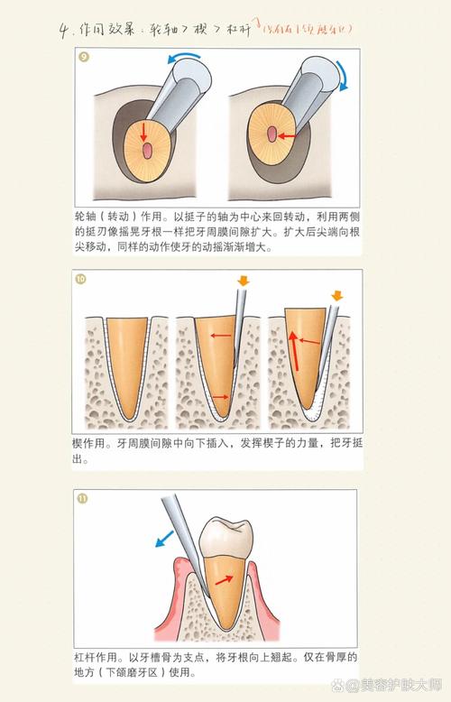 在家拔牙真的可行吗?有哪些潜在风险和正确操作步骤?医生为何不建议自行拔牙?-图2 在家拔牙真的可行吗?有哪些潜在风险和正确操作步骤?医生为何不建议自行拔牙?-图2