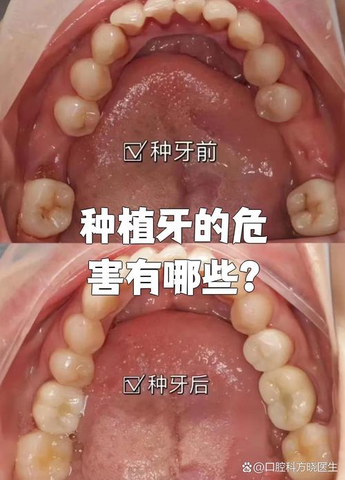 哪些人群或健康状况下不适合种植牙？这些禁忌症和潜在风险你必须提前了解！-图3