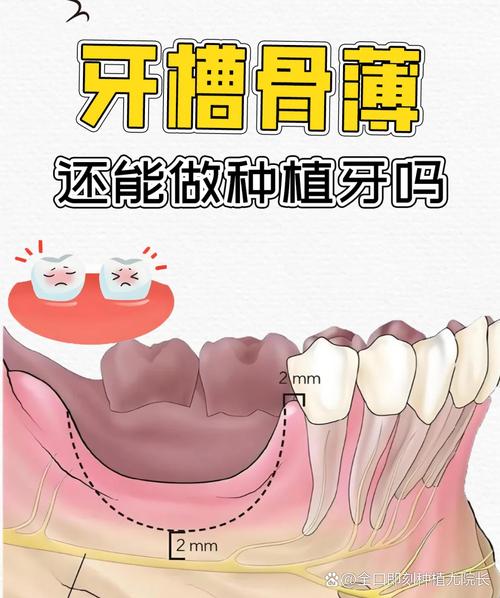 种牙选择自体骨移植时，取骨和种植过程会有哪些疼痛表现？术后疼痛程度如何有效缓解？-图1