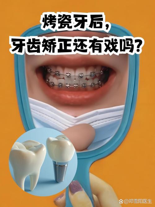 做过美牙冠后还能进行牙齿矫正吗?美牙冠会影响正畸效果或对牙齿健康造成额外风险吗?-图3 做过美牙冠后还能进行牙齿矫正吗?美牙冠会影响正畸效果或对牙齿健康造成额外风险吗?-图3