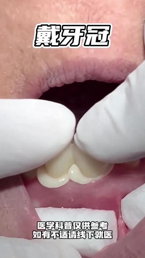 做过美牙冠后还能进行牙齿矫正吗？美牙冠会影响正畸效果或对牙齿健康造成额外风险吗？-图1