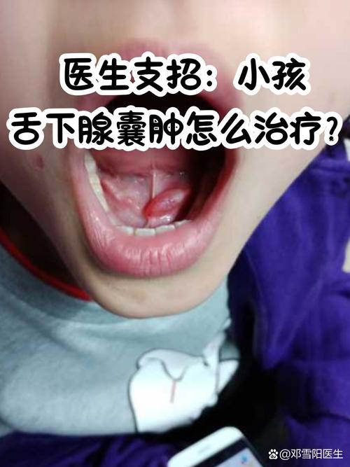 口腔囊肿治疗方法有哪些？不同类型囊肿如何选择最佳方案？术后复发率高吗？-图2