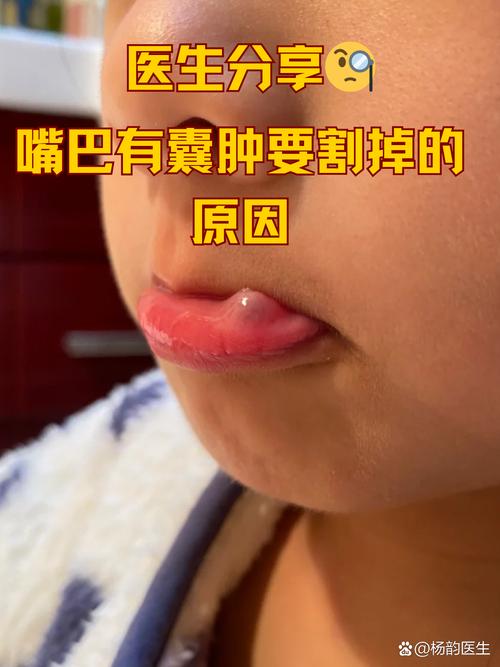 口腔囊肿治疗方法有哪些?不同类型囊肿如何选择最佳方案?术后复发率高吗?-图1 口腔囊肿治疗方法有哪些?不同类型囊肿如何选择最佳方案?术后复发率高吗?-图1