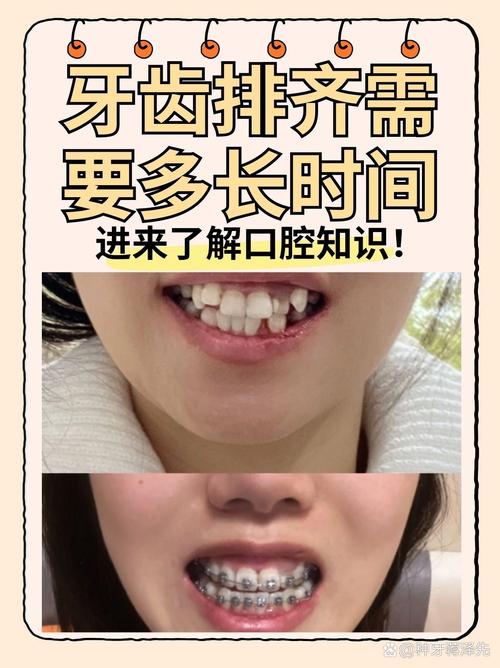 牙齿不齐有哪些解决方法?不同矫正方式适合哪些情况?效果和费用如何?-图3 牙齿不齐有哪些解决方法?不同矫正方式适合哪些情况?效果和费用如何?-图3