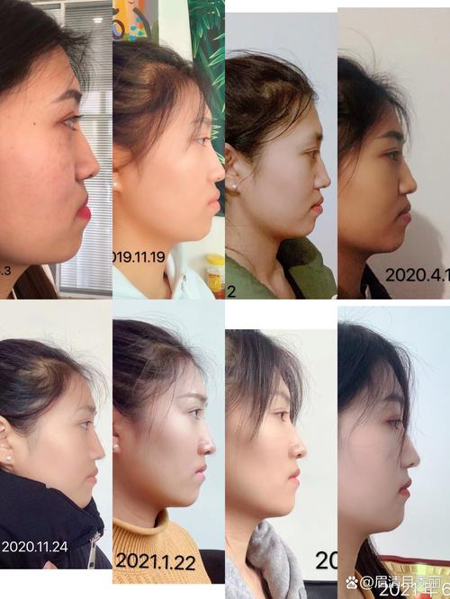 骨性地包天若仅依赖正畸矫正，效果真能达到预期吗？是否会对骨骼结构造成不良影响或增加复发风险？-图2