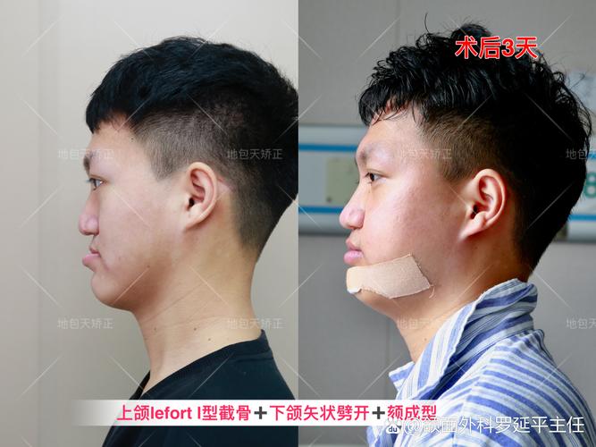 骨性地包天若仅依赖正畸矫正,效果真能达到预期吗?是否会对骨骼结构造成不良影响或增加复发风险?-图1 骨性地包天若仅依赖正畸矫正,效果真能达到预期吗?是否会对骨骼结构造成不良影响或增加复发风险?-图1