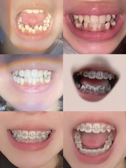 口腔正畸照片拍摄角度的选择有哪些关键标准？不同角度如何精准捕捉牙齿与颌骨信息以影响矫正方案制定？-图2