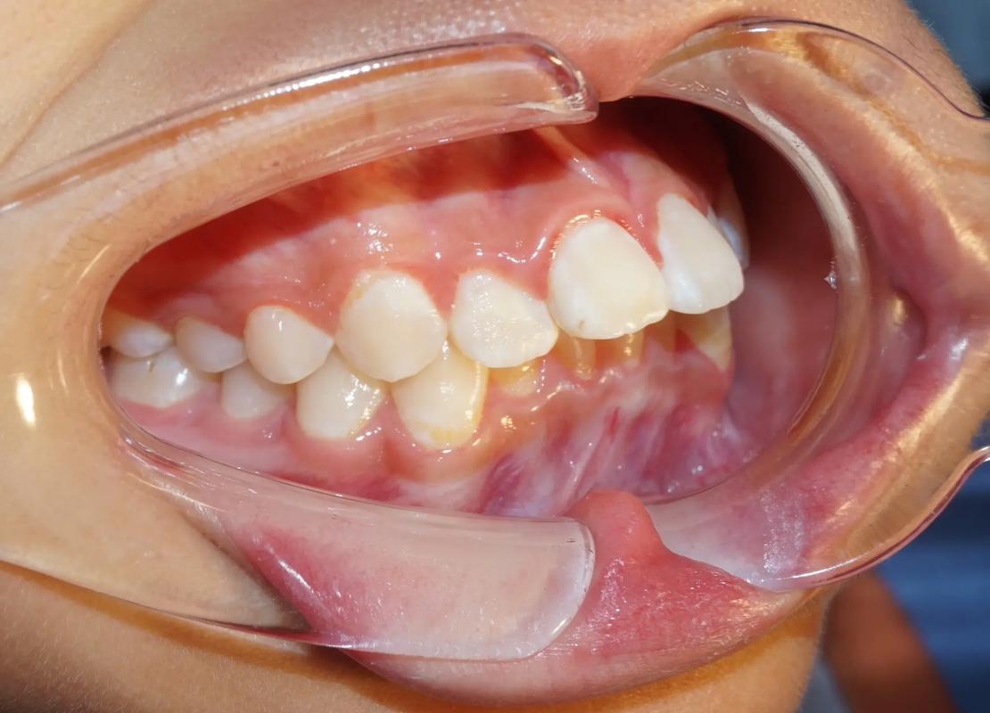 口腔正畸照片拍摄角度的选择有哪些关键标准？不同角度如何精准捕捉牙齿与颌骨信息以影响矫正方案制定？-图1