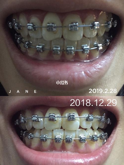牙齿正畸期间更换钢丝的次数究竟由什么决定?是固定次数还是因牙齿矫正阶段、个体差异而变化?-图1 牙齿正畸期间更换钢丝的次数究竟由什么决定?是固定次数还是因牙齿矫正阶段、个体差异而变化?-图1