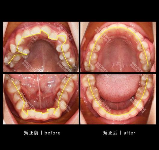 正畸治疗该选国外还是国内？效果、费用、技术差异全面解析，如何根据自身需求做最优决策？-图2