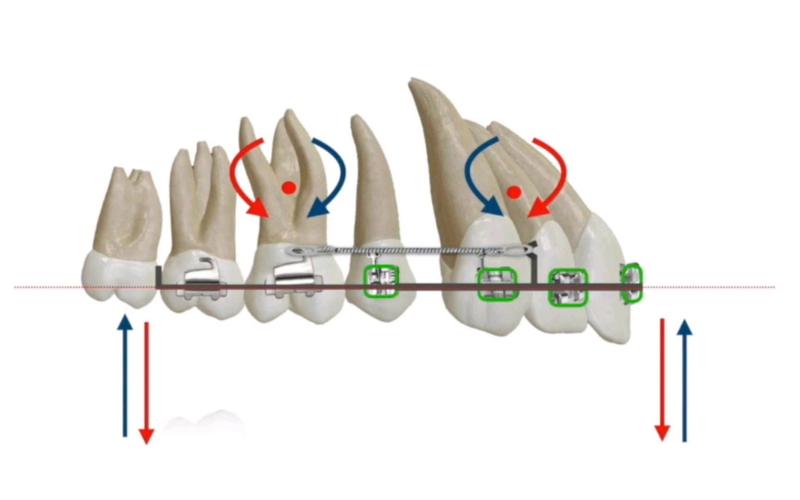 正畸打转矩到底是什么？为何这个操作能精准控制牙齿角度？看完讲解视频你就懂了！-图2