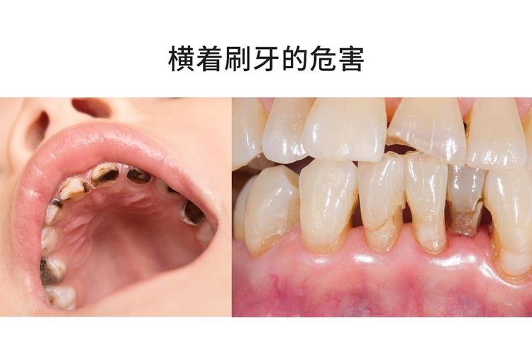 刷牙方法不对竟埋下这么多健康隐患?这些错误习惯如何悄悄损伤牙齿与牙龈?-图2 刷牙方法不对竟埋下这么多健康隐患?这些错误习惯如何悄悄损伤牙齿与牙龈?-图2