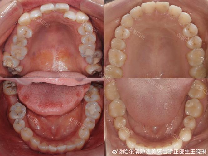 口腔正畸真的能把歪长的智齿掰正吗?原理、效果及适用条件大揭秘-图3 口腔正畸真的能把歪长的智齿掰正吗?原理、效果及适用条件大揭秘-图3