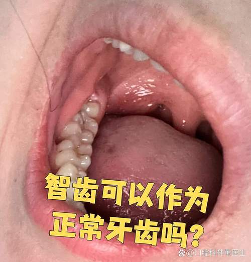 口腔正畸真的能把歪长的智齿掰正吗?原理、效果及适用条件大揭秘-图1 口腔正畸真的能把歪长的智齿掰正吗?原理、效果及适用条件大揭秘-图1