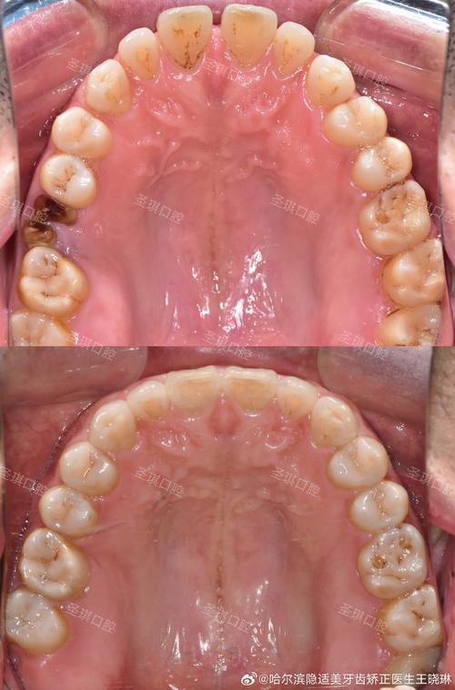 口腔正畸真的能把歪长的智齿掰正吗？原理、效果及适用条件大揭秘-图2