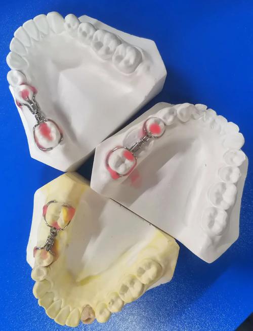 口腔正畸卡环弯制视频教学中，如何快速掌握不同类型卡环的弯制要领与临床应用技巧？-图2