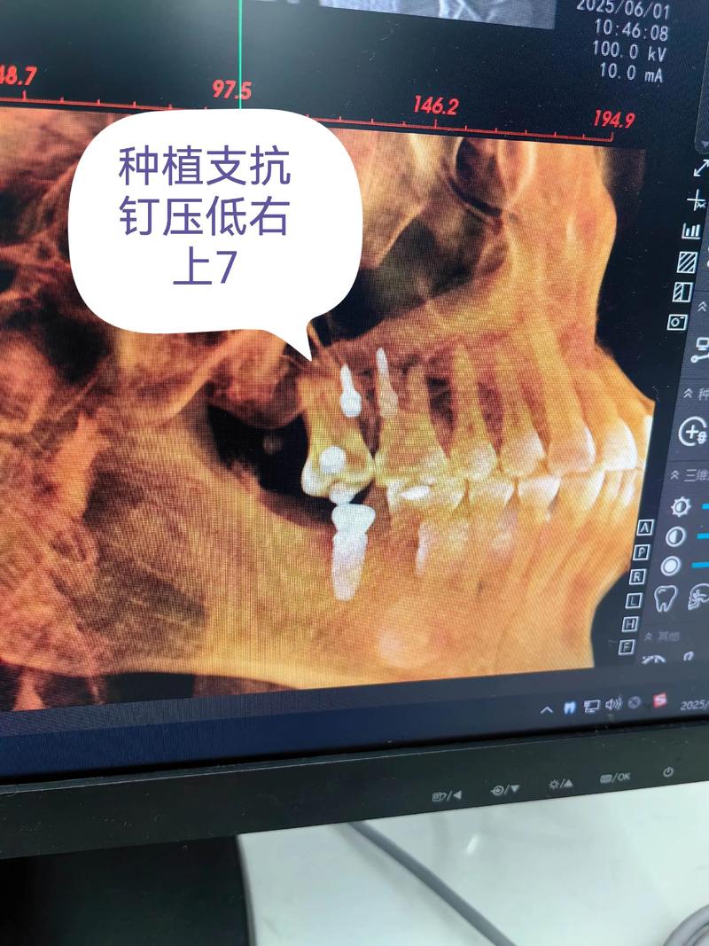 种植支抗钉植入的具体操作步骤有哪些？不同牙位植入时如何选择入路角度及避免损伤重要解剖结构？-图3