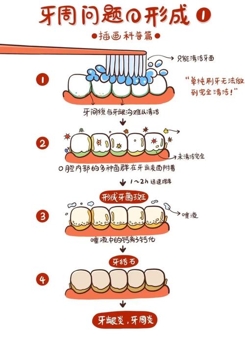 牙周炎的具体治疗方法有哪些?不同严重程度的患者该如何选择针对性方案?治疗期间有哪些注意事项需警惕?-图3 牙周炎的具体治疗方法有哪些?不同严重程度的患者该如何选择针对性方案?治疗期间有哪些注意事项需警惕?-图3